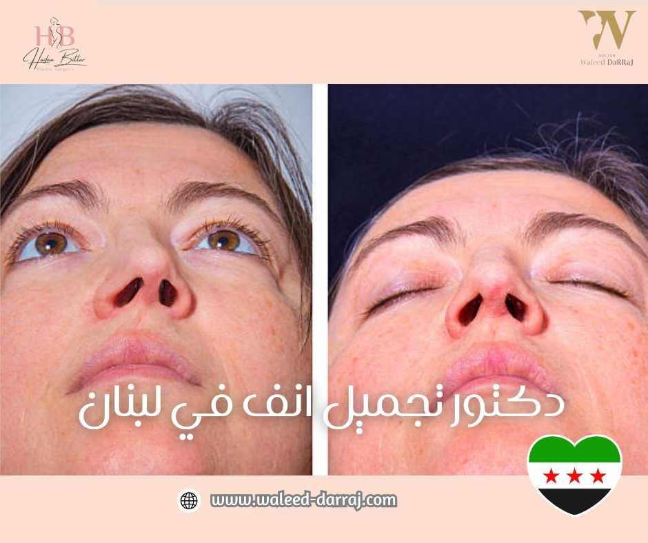 دكتور تجميل انف في لبنان