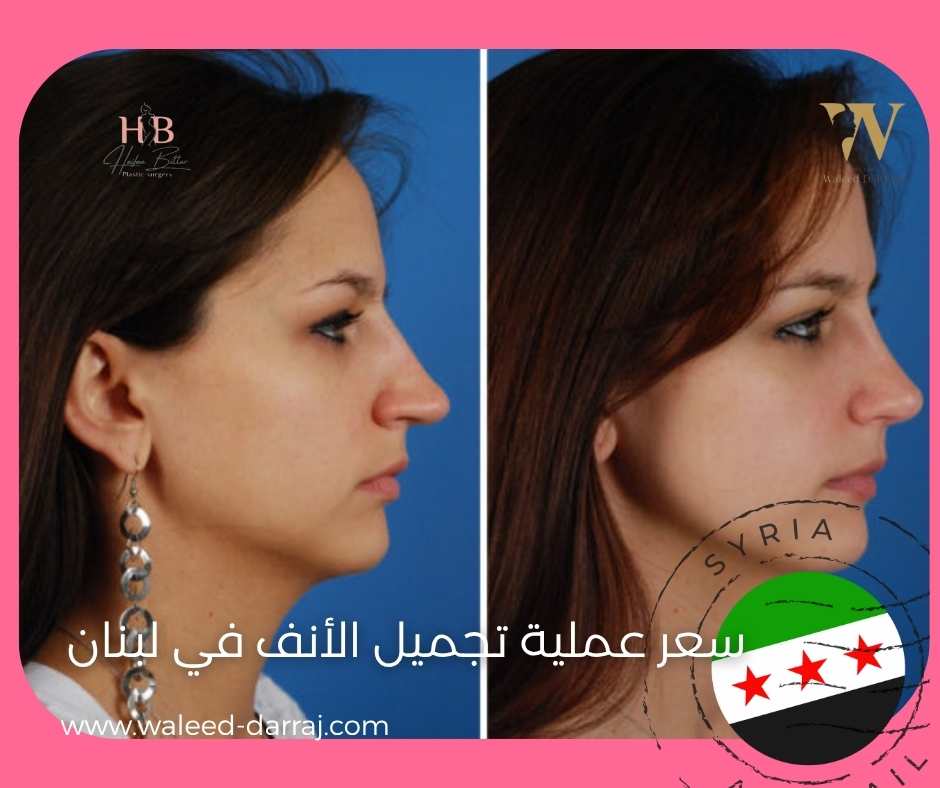 سعر عملية تجميل الأنف في لبنان