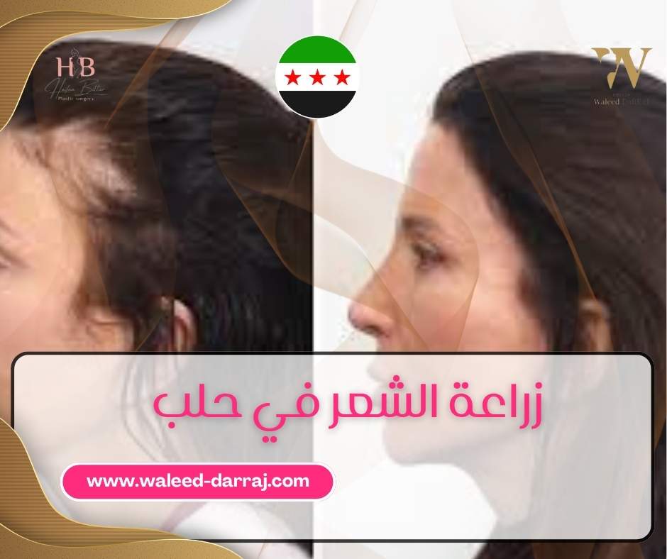 زراعة الشعر في حلب