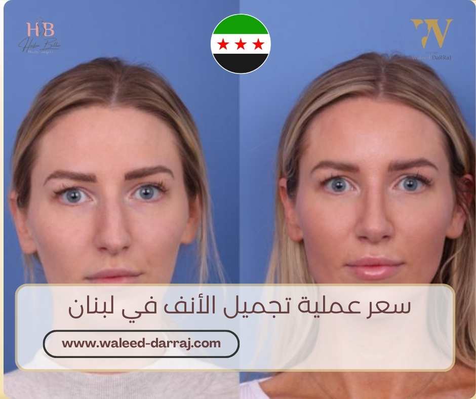 سعر عملية تجميل الأنف في لبنان