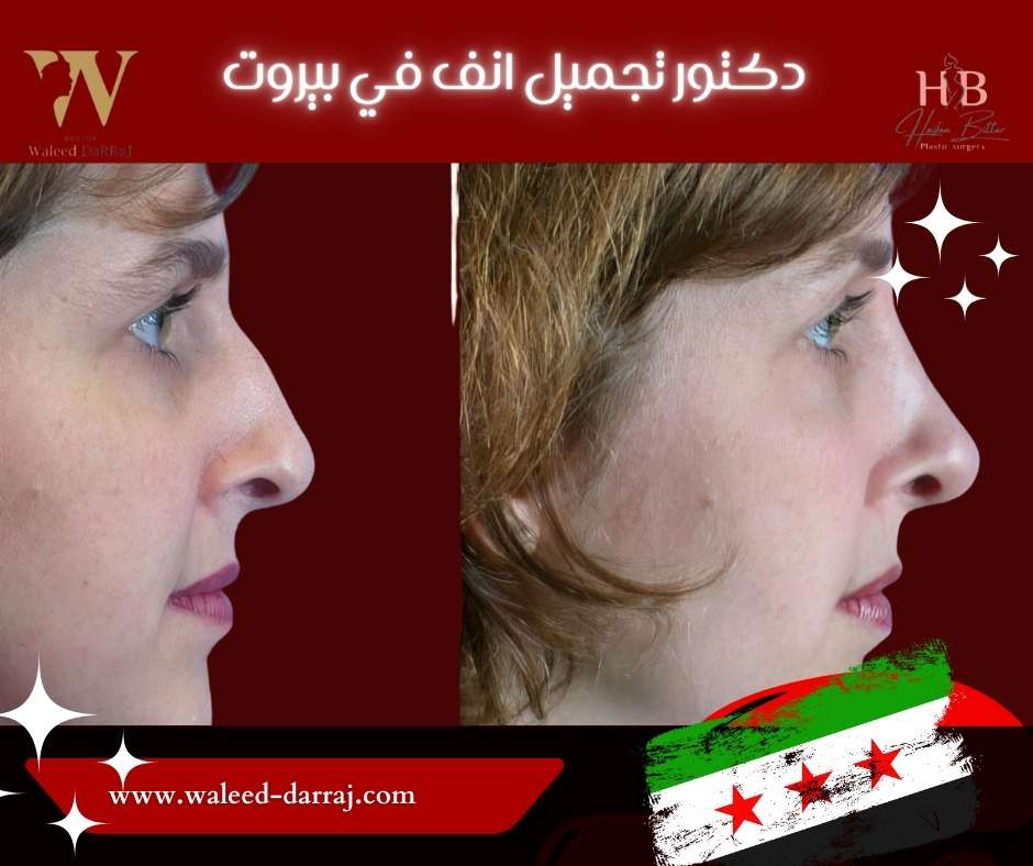 دكتور تجميل انف في بيروت