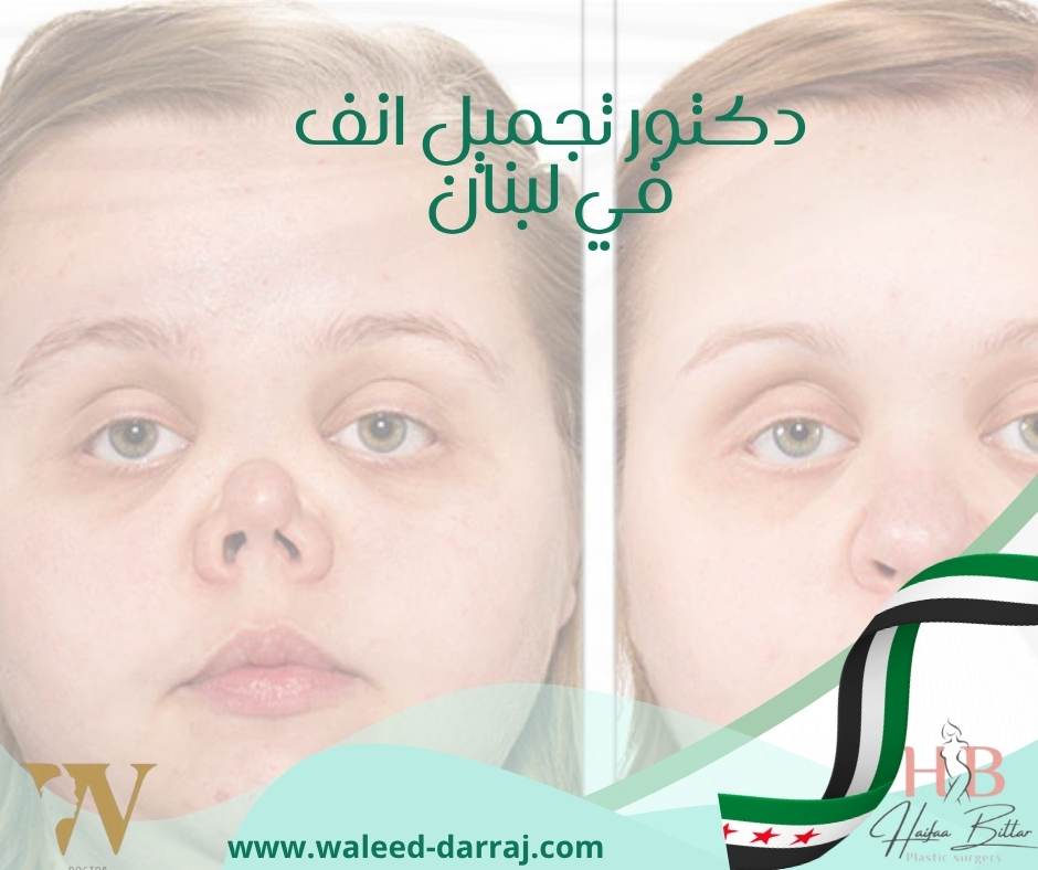 دكتور تجميل انف في لبنان