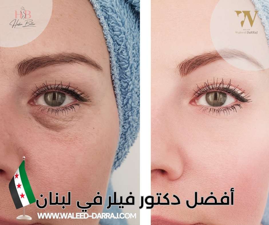 أفضل دكتور فيلر في لبنان