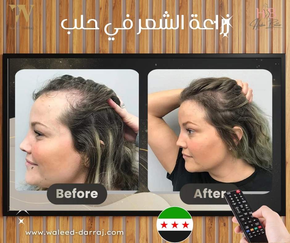 زراعة الشعر في حلب