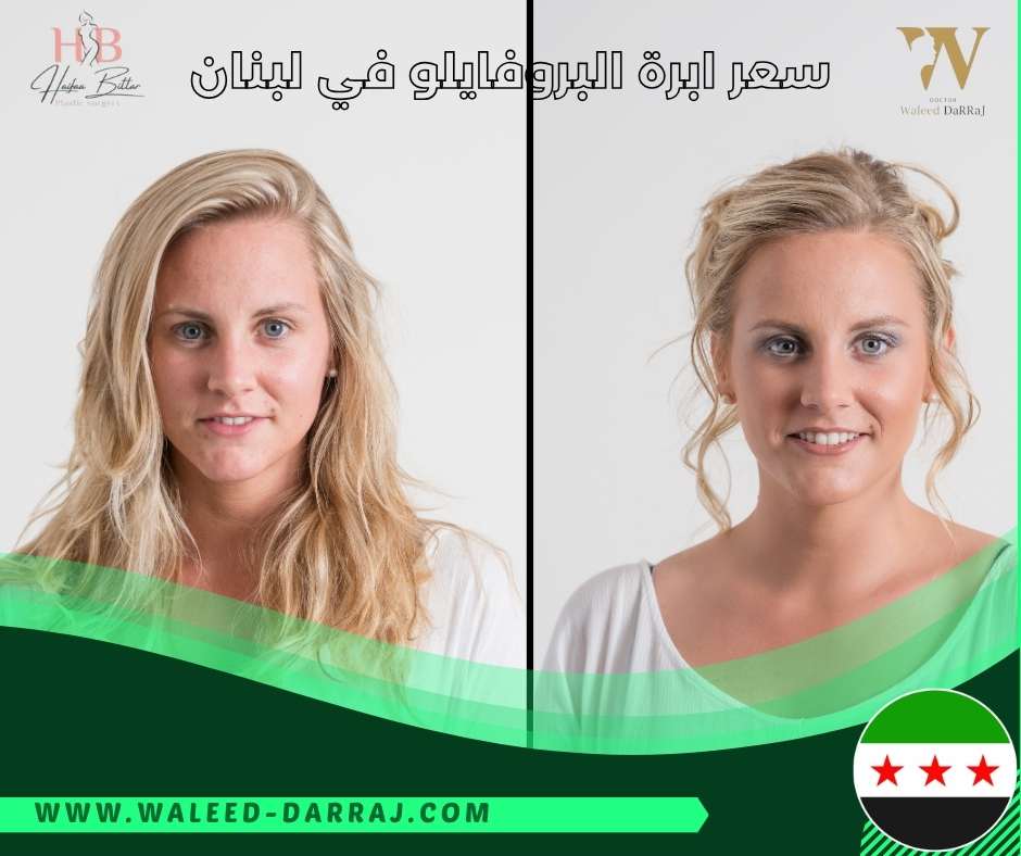 سعر ابرة البروفايلو في لبنان