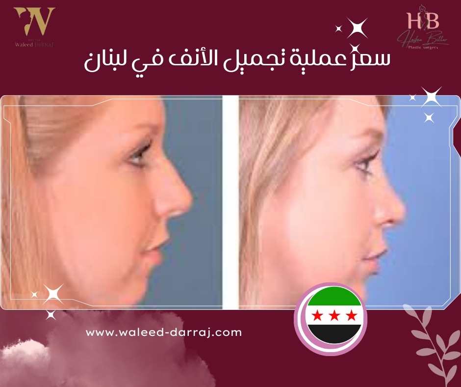 سعر عملية تجميل الأنف في لبنان