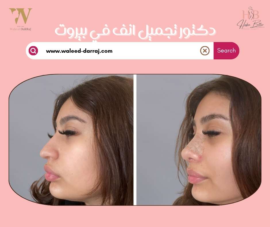 دكتور تجميل انف في بيروت