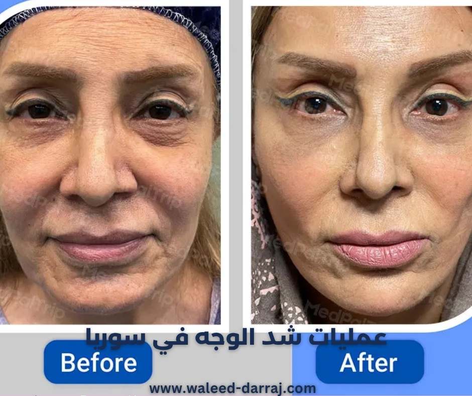 عمليات شد الوجه في سوريا