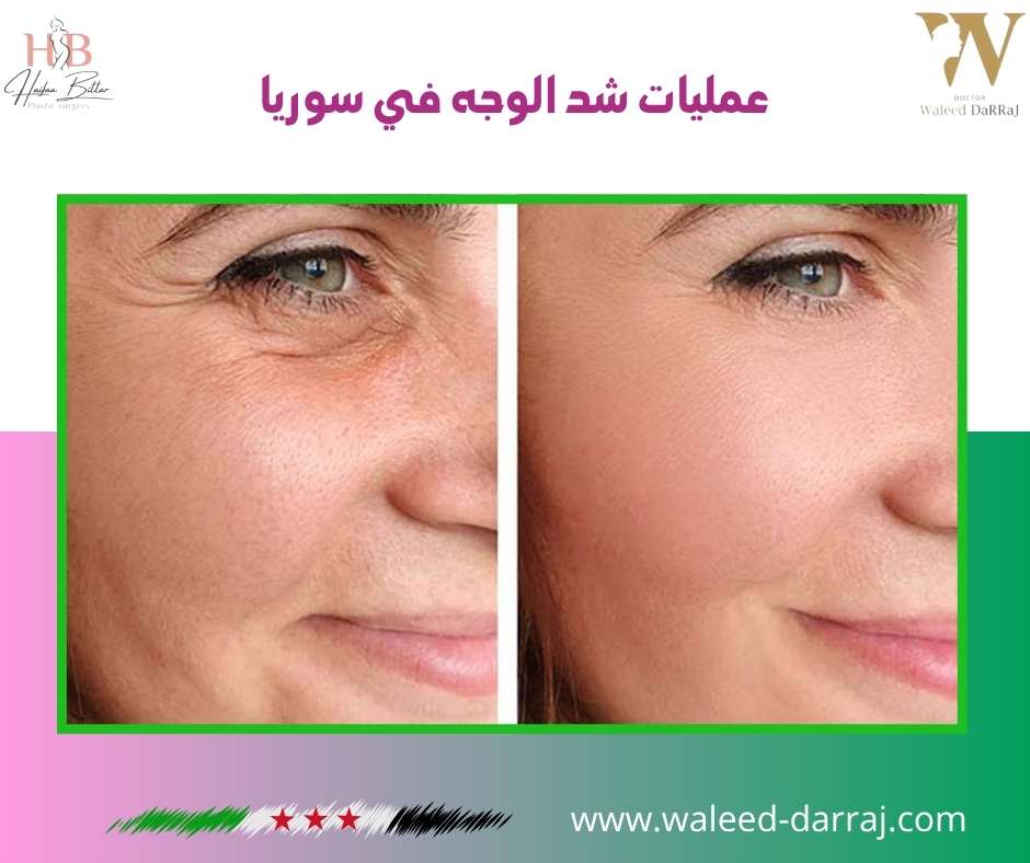 عمليات شد الوجه في سوريا