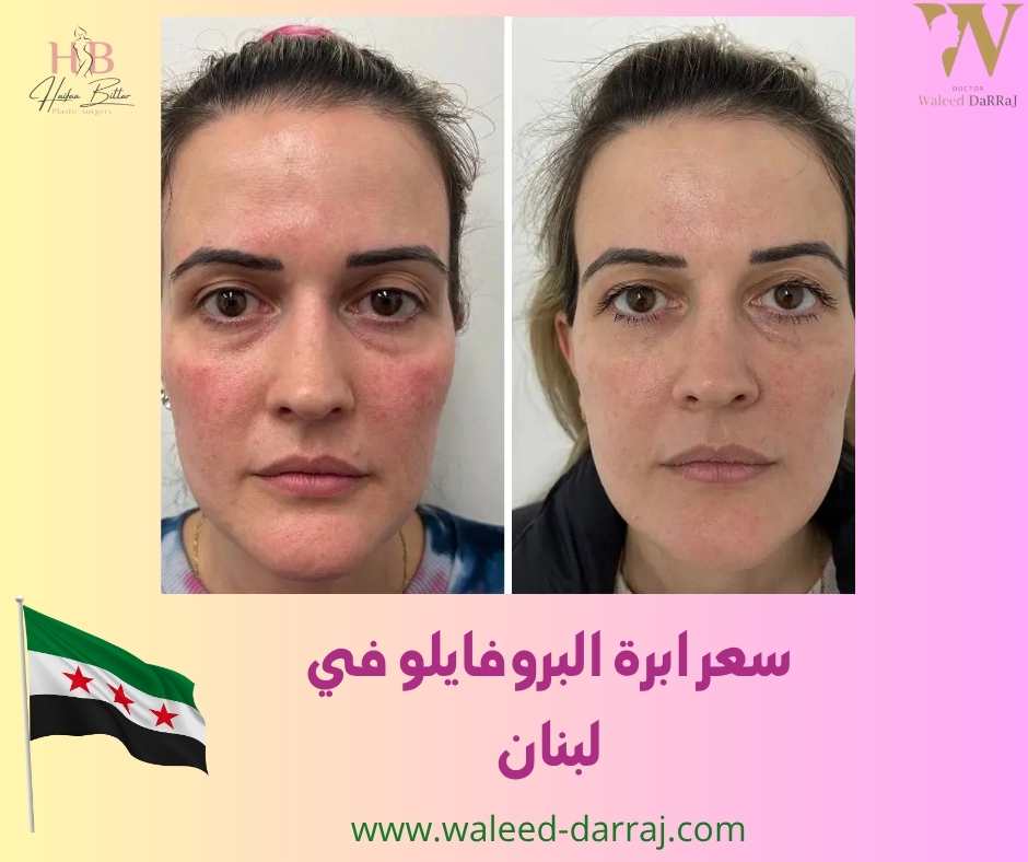 سعر ابرة البروفايلو في لبنان