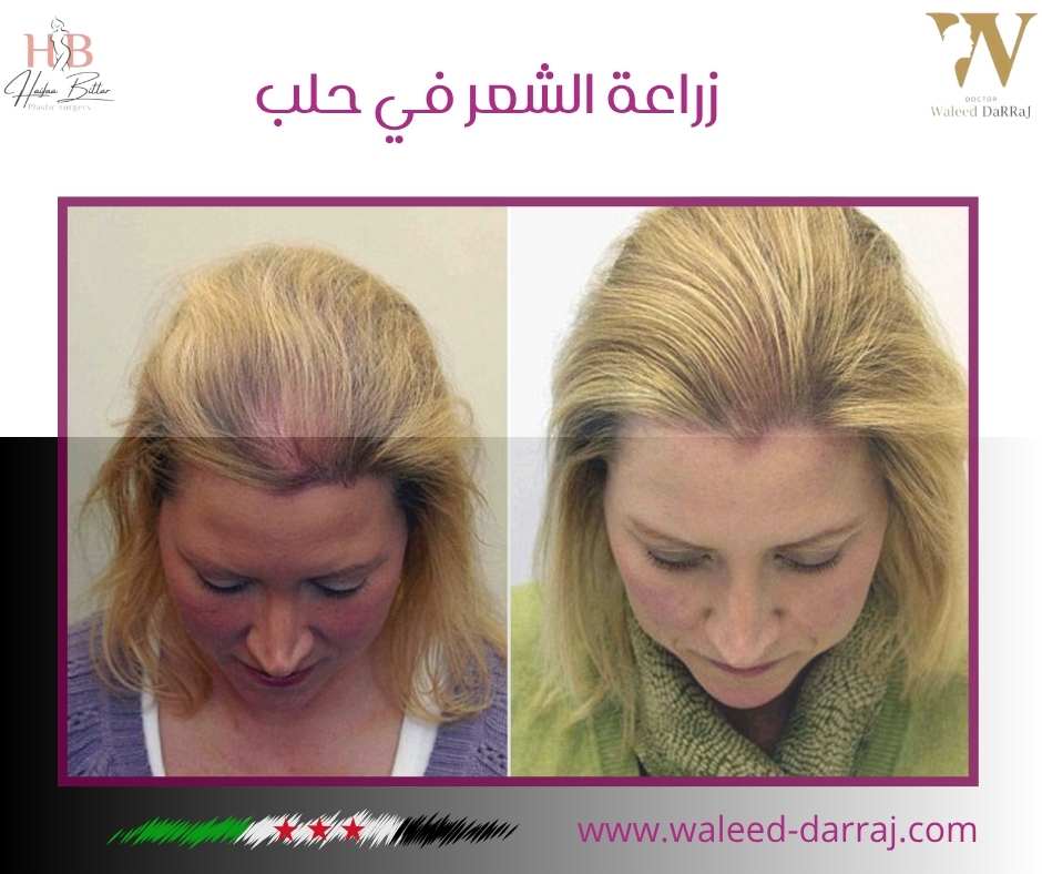 زراعة الشعر في حلب