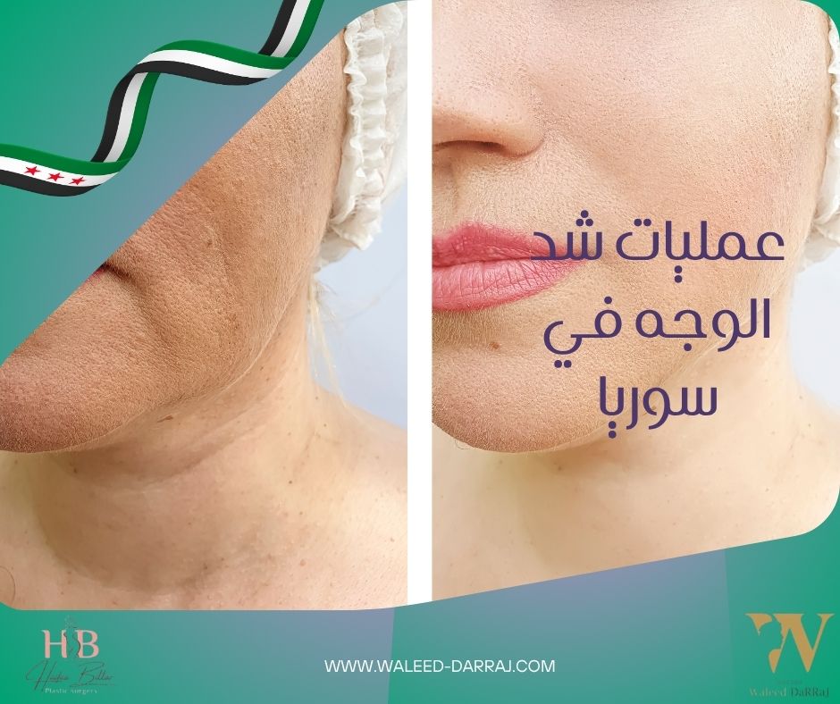 عمليات شد الوجه في سوريا