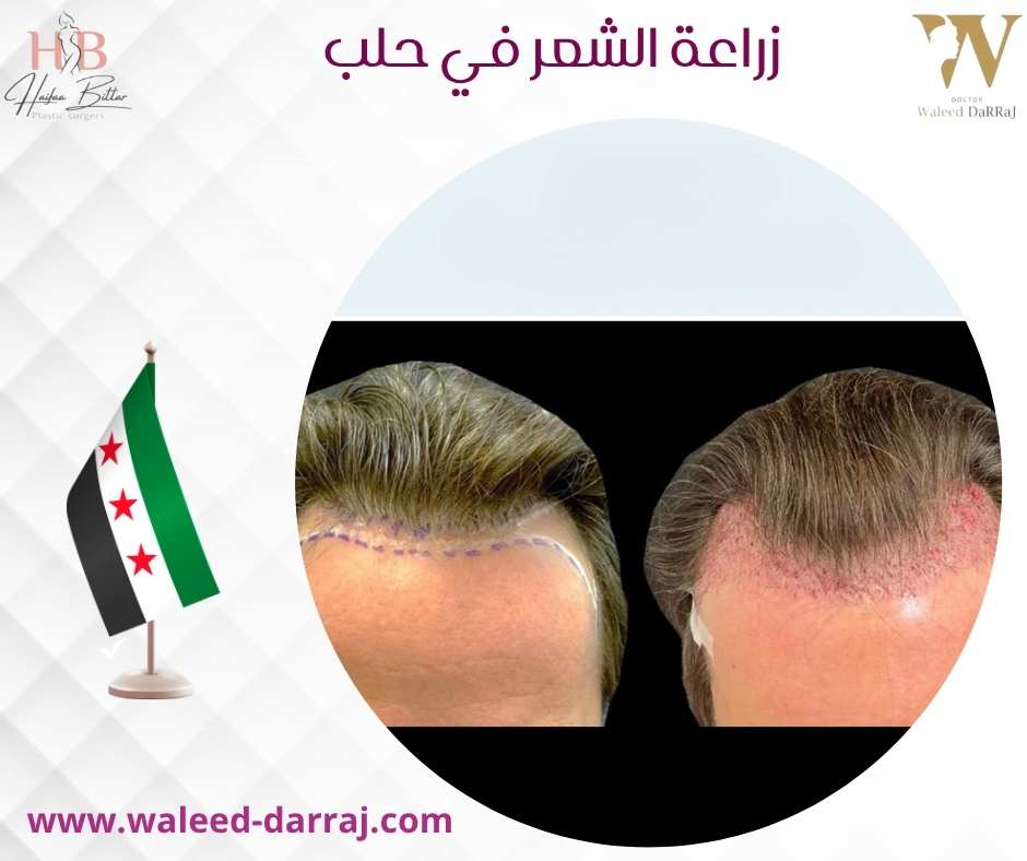 زراعة الشعر في حلب