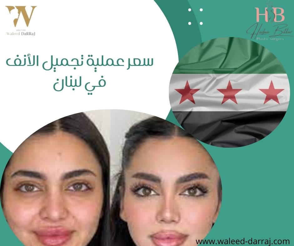 سعر عملية تجميل الأنف في لبنان