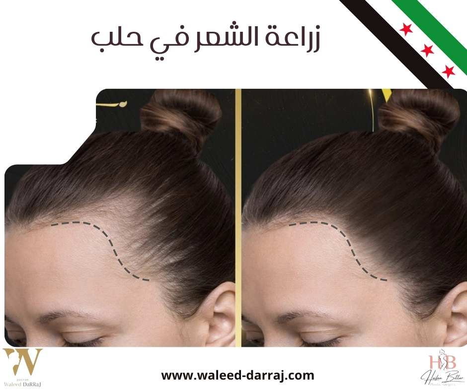 زراعة الشعر في حلب