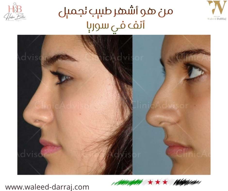 من هو أشهر طبيب تجميل أنف في سوريا