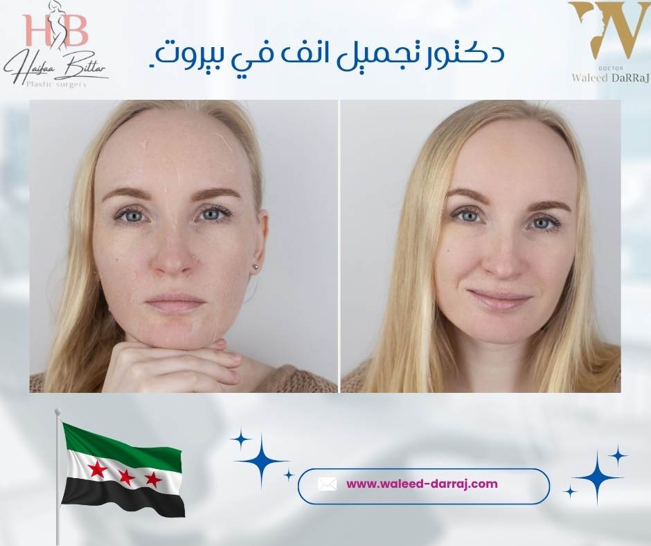 دكتور تجميل انف في بيروت
