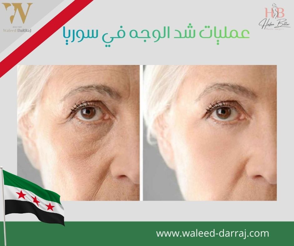 عمليات شد الوجه في سوريا