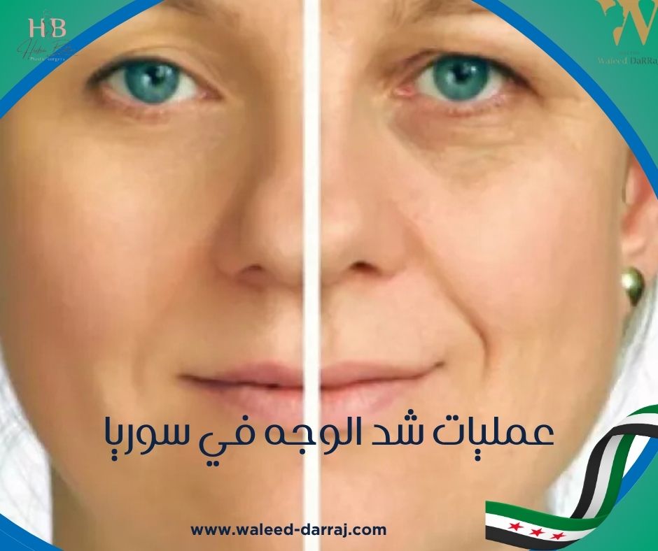 عمليات شد الوجه في سوريا