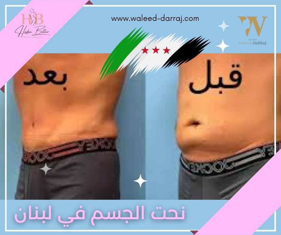 نحت الجسم في لبنان