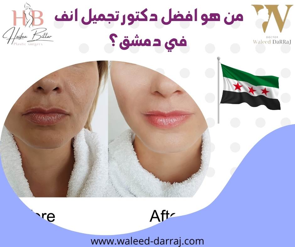 من هو افضل دكتور تجميل انف في دمشق