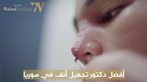 أفضل دكتور تجميل أنف في سوريا