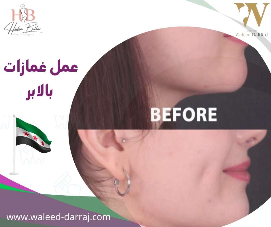 عمل غمازات بالابر