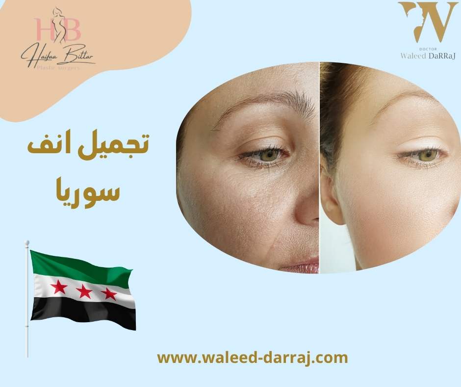 تجميل انف سوريا