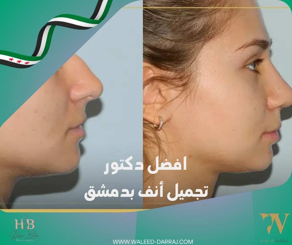 افضل دكتور تجميل أنف بدمشق