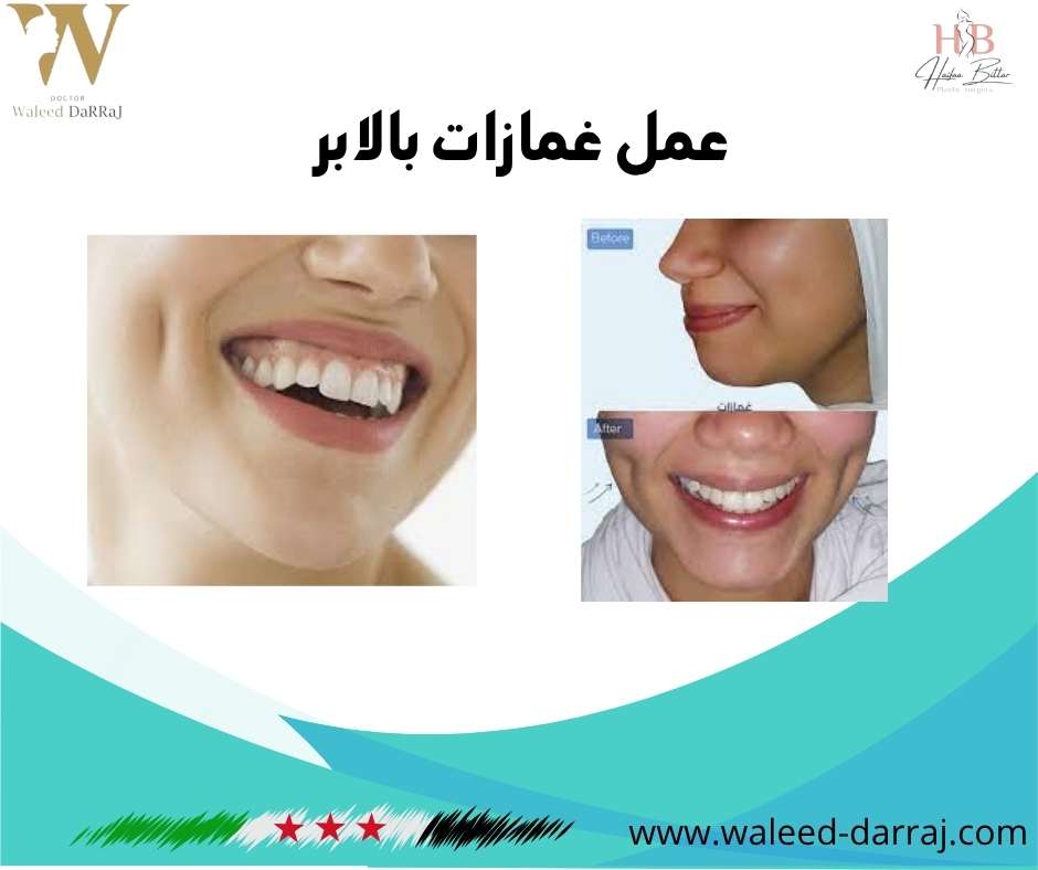 عمل غمازات بالابر