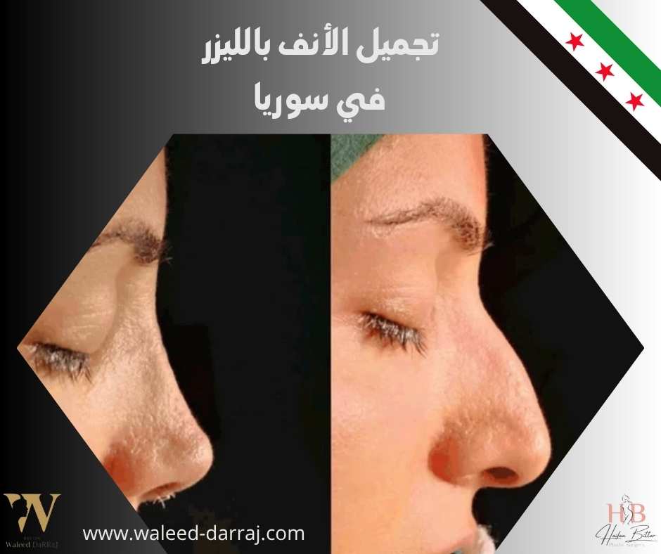 تجميل الأنف بالليزر في سوريا