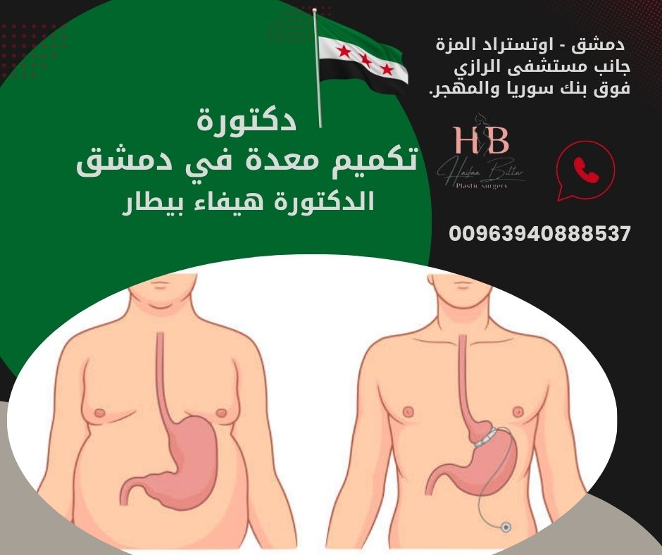 قبل وبعد قص معدة في دمشق