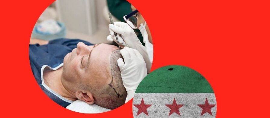افضل مركز لزراعة الشعر في لبنان