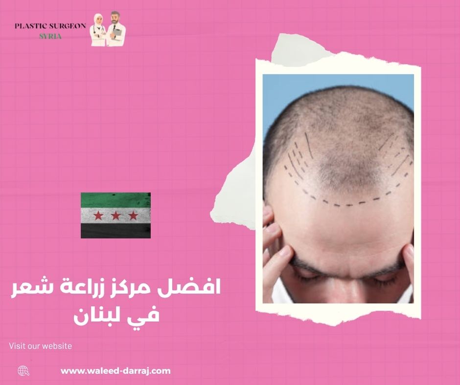 افضل مركز زراعة شعر في لبنان