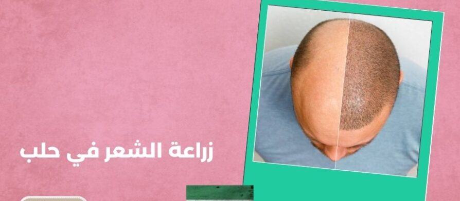 زراعة الشعر في حلب