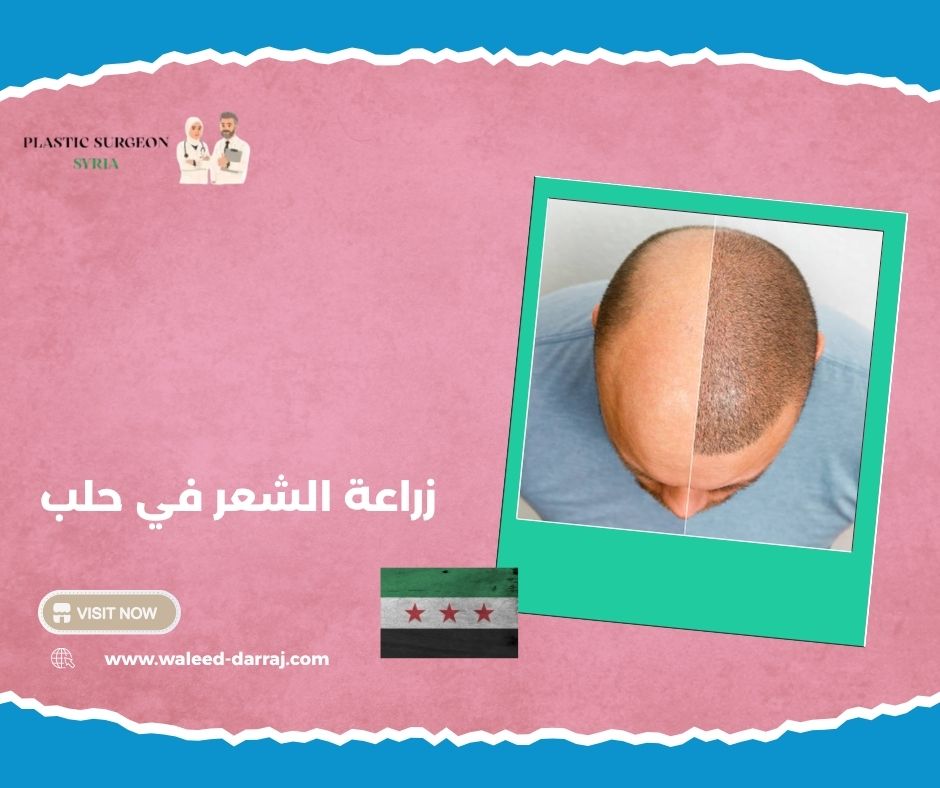 زراعة الشعر في حلب