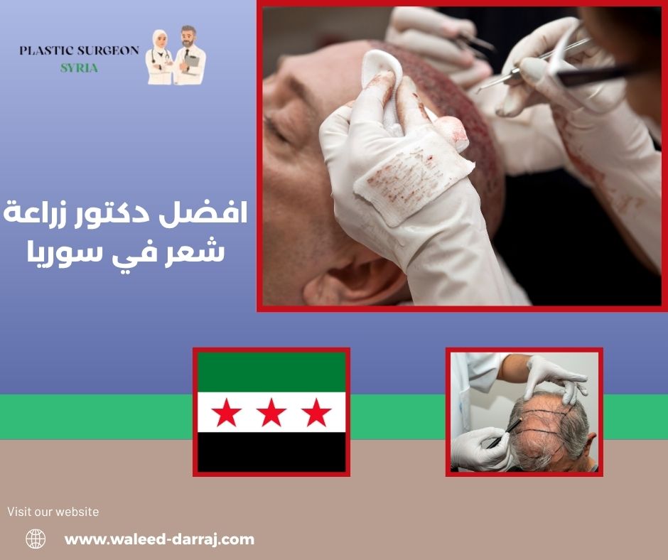 افضل دكتور زراعة شعر في سوريا