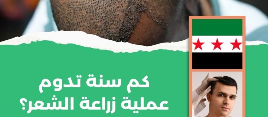 كم سنة تدوم عملية زراعة الشعر؟