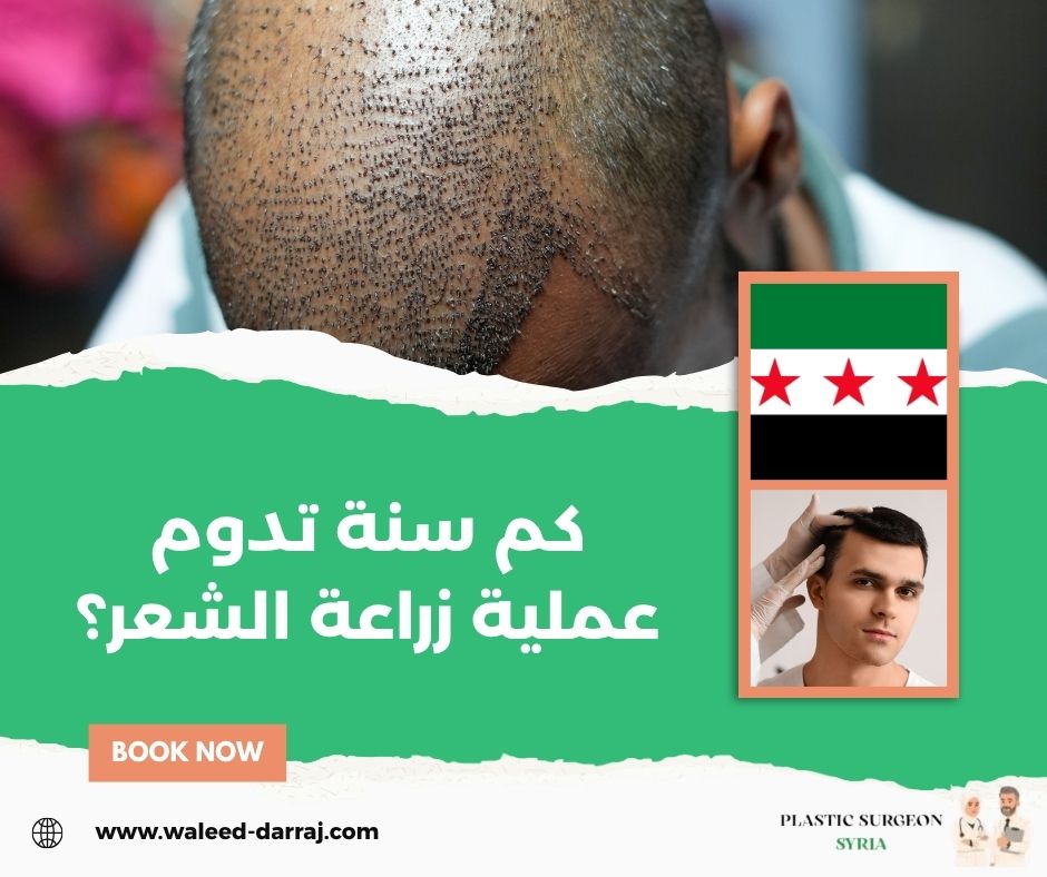 كم سنة تدوم عملية زراعة الشعر؟