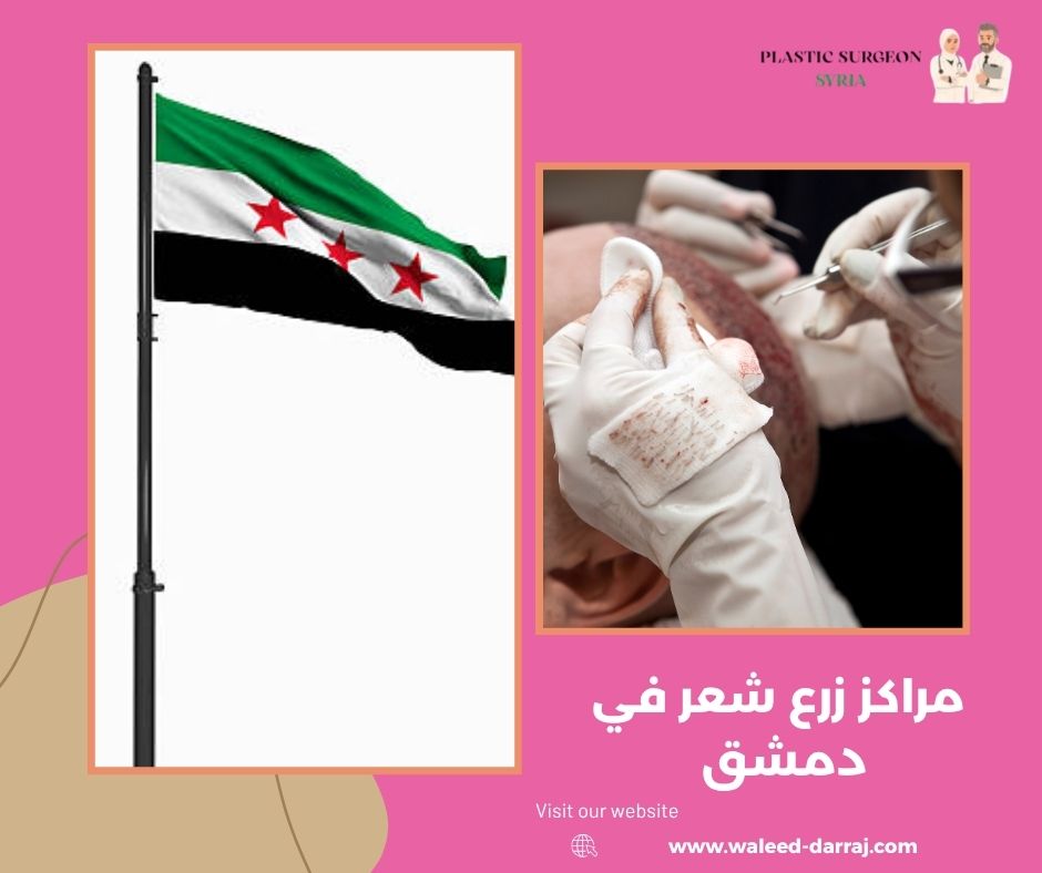 مراكز زرع شعر في دمشق