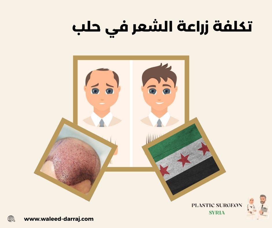 تكلفة زراعة الشعر في حلب