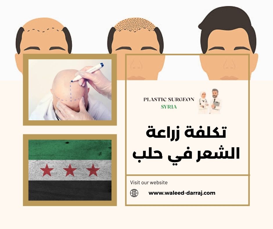 تكلفة زراعة الشعر في حلب